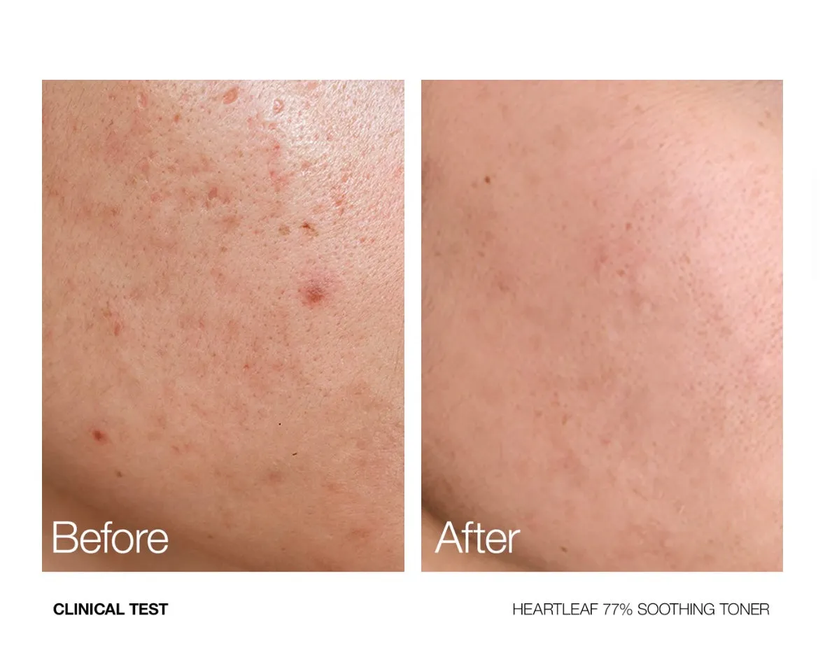 Anua Heartleaf 77% Soothing Toner - 250ml | أنوا تونر مهدئ للبشرة - 250 مل